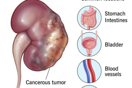 Leiomyosarcoma