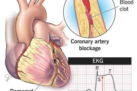 STEMI Heart Attack