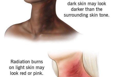 Radiation Burn