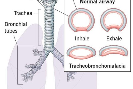 Tracheobronchomalacia (TBM)