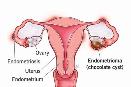 Ovarian Endometrioma (Chocolate Cyst)