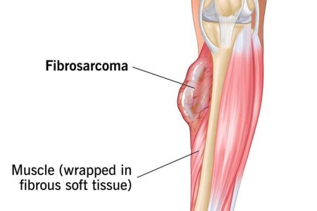 Fibrosarcoma