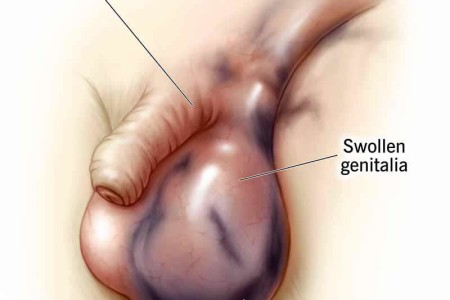 Fournier’s Gangrene