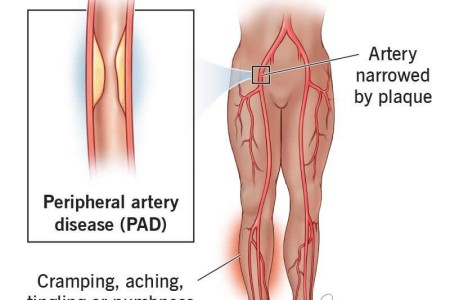 Claudication