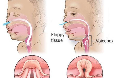 Laryngomalacia