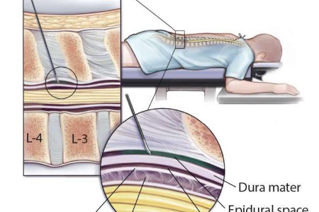Lumbar Epidural Steroid Injection