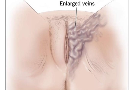 Vulvar Varicosities
