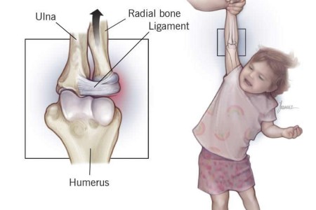 Nursemaid Elbow