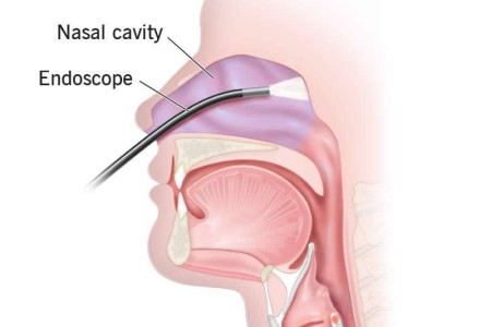 Nasal Endoscopy