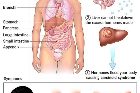 Carcinoid Syndrome