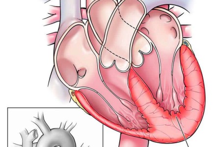 Myocarditis