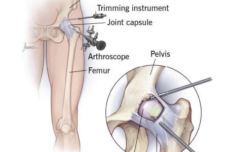 Hip Arthroscopy