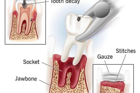 Tooth Extraction