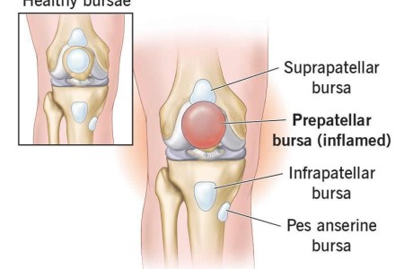 Prepatellar Bursitis (Knee Bursitis)