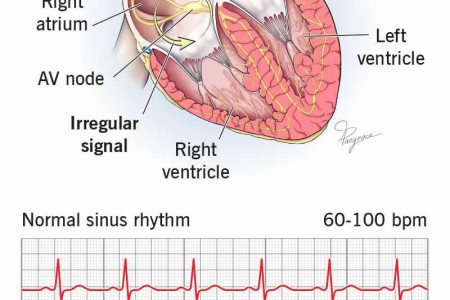 Supraventricular Tachycardia (SVT)