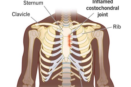 Costochondritis