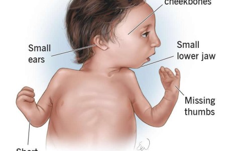 Nager Syndrome