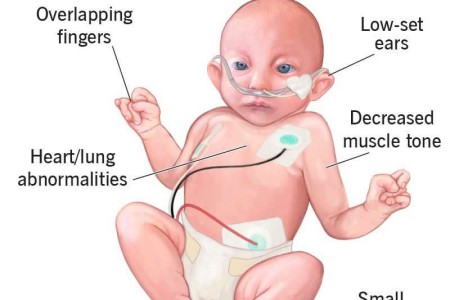 Edwards Syndrome (Trisomy 18)