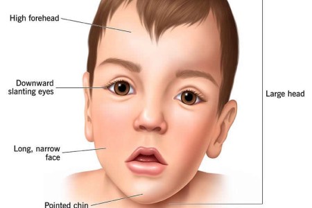 Sotos Syndrome