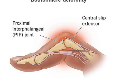 Boutonnière Deformity