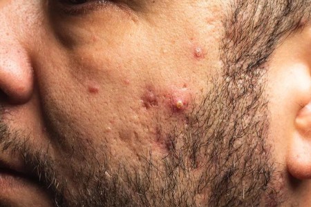 When Should Men See a Dermatologist for Adult Acne?