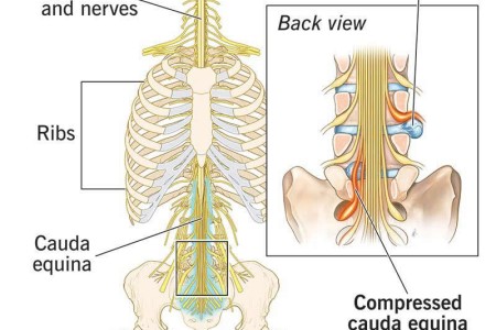 Cauda Equina Syndrome