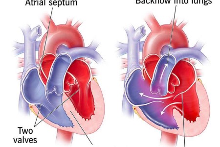 Atrioventricular Canal Defect