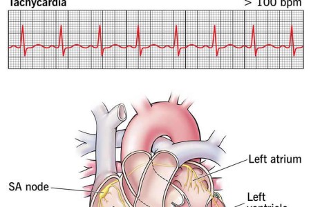 Tachycardia