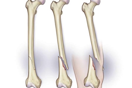 Oblique Fracture