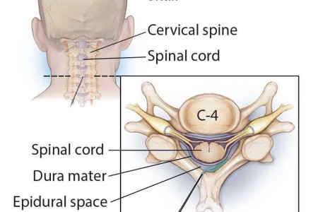 Cervical Epidural Steroid Injection