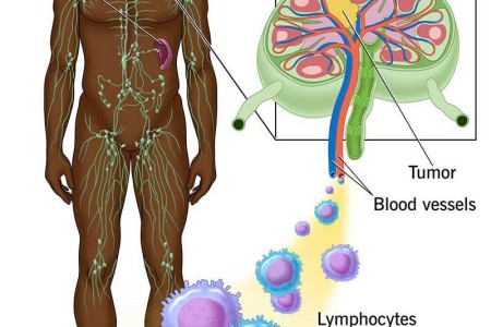 Lymphoma