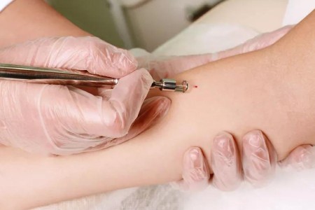 How Skin Cancer Is Found and Removed — At the Same Appointment