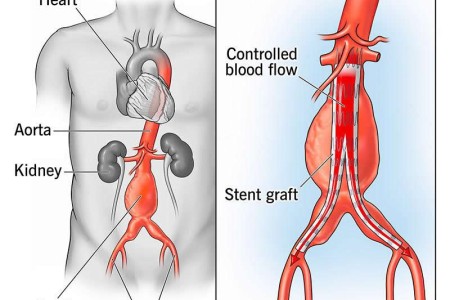 Endovascular Aneurysm Repair (EVAR)