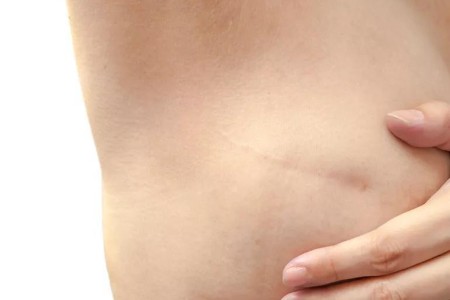 Implants or Tissue Transfer: What’s Right for You After a Mastectomy?