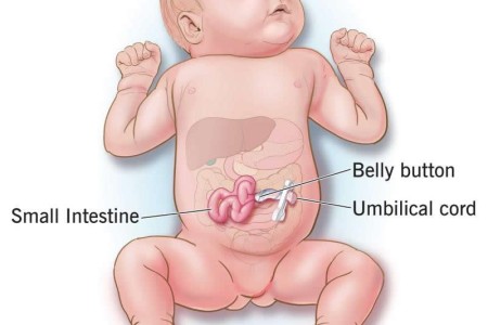 Gastroschisis