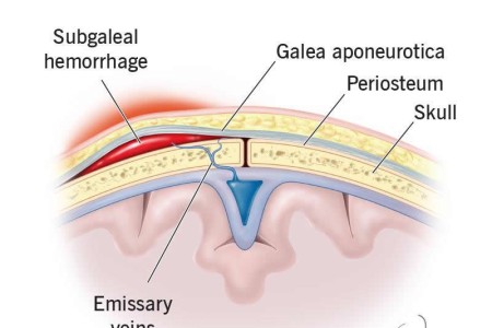 Subgaleal Hemorrhage in Newborns