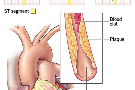 NSTEMI: Non-ST-Elevation Myocardial Infarction (Heart Attack)