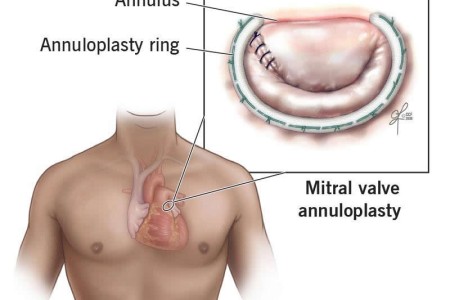 Annuloplasty