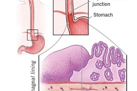 Intestinal Metaplasia