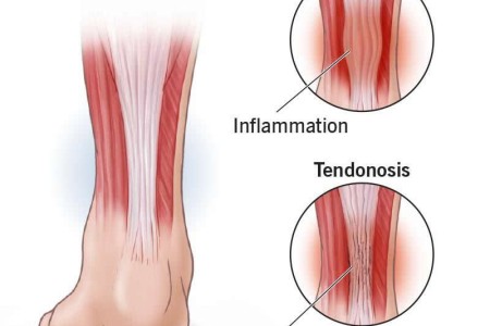 Tendinopathy