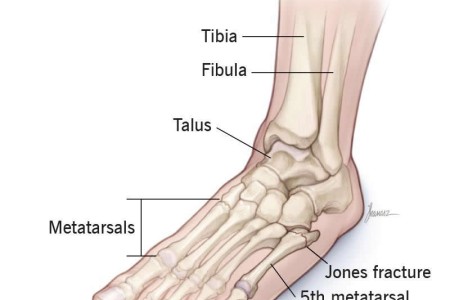 Jones Fracture