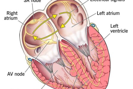 Paroxysmal Supraventricular Tachycardia (PSVT)