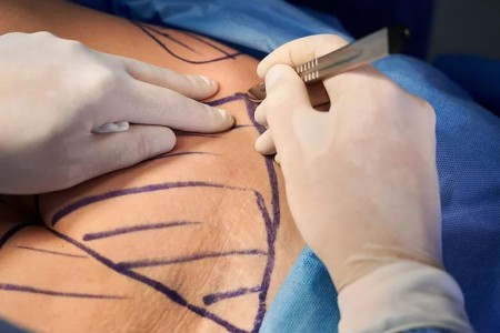 5 Ways To Fight Excess Skin After Bariatric Surgery