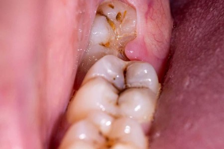 Impacted Wisdom Teeth