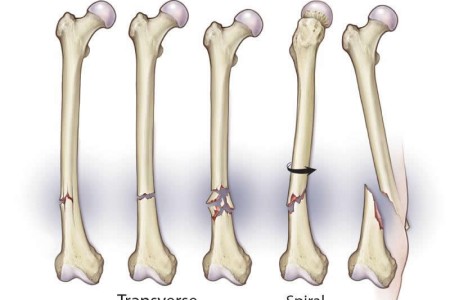 Spiral Fracture