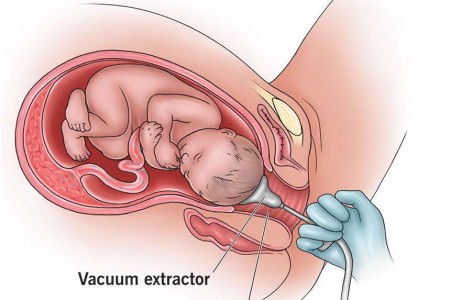 Vacuum Extraction Delivery