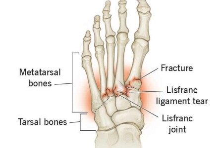 Lisfranc Injury