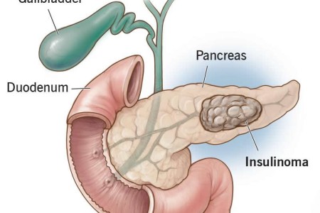 Insulinoma