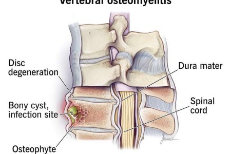 Vertebral Osteomyelitis