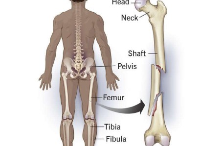 Segmental Fracture